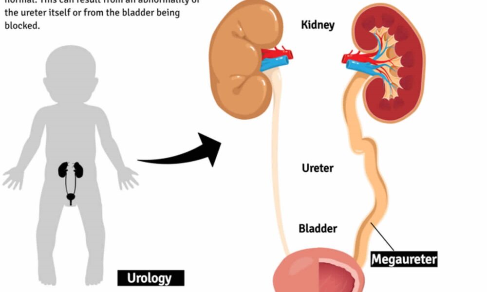 10-year-old Boy from Myanmar with a Congenital Urinary Tract Defect ...